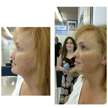 Vortex - High focused ultrasound SMAS&Dermis Lift as known as Ultherapy or HIFU - Eyelash Service Near Me - Los Angeles, California Vortex - High focused ultrasound SMAS&Dermis Lift as known as Ultherapy or HIFU - Eyelash Service Near Me - Los Angeles, California