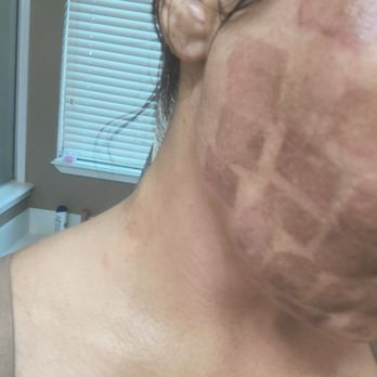 The Spa Associate - This is all over my face - Laser Hair Removal Near Me - Bellaire, Texas The Spa Associate - This is all over my face - Laser Hair Removal Near Me - Bellaire, Texas
