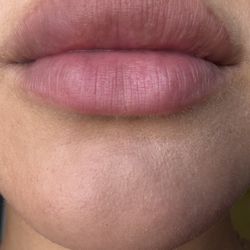 I had lip filler done by Miranda 2 months ago and unfortunately I have been unhappy with my results. My top lip is NOTICEABLY UNEVEN and OVE