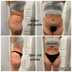 Enhanced Body Studio - Cavitation and Radio Frequency Therapy