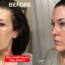 Livio Med Spa - Before and after jaw filler correction at Livio
