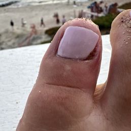Infected toe from pedicure Infected toe from pedicure