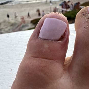 TK Nails - Infected toe from pedicure - Nail Salons Near Me - Los Angeles, California TK Nails - Infected toe from pedicure - Nail Salons Near Me - Los Angeles, California