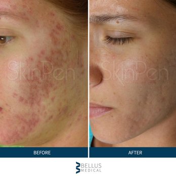 Pure Skin MedSpa - Before/After Results from the ONLY FDA-CLEARED Micro Needling SkinPen - Medical Spas Near Me - Phoenix, Arizona Pure Skin MedSpa - Before/After Results from the ONLY FDA-CLEARED Micro Needling SkinPen - Medical Spas Near Me - Phoenix, Arizona