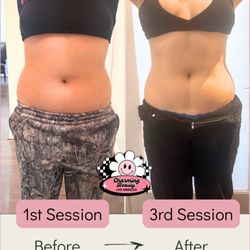 Before and after 3 Sessions Body Sculpting + Lymphatic Drainage