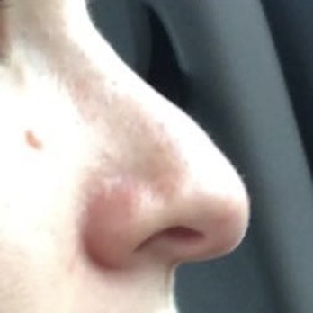 Thomas W Loeb, MD - This is an AFTER photo from my rhinoplasty with Dr. Loeb. You can see the polly beak deformity and drooping tip. - Cosmetic Surgeons Near Me - New York, New York Thomas W Loeb, MD - This is an AFTER photo from my rhinoplasty with Dr. Loeb. You can see the polly beak deformity and drooping tip. - Cosmetic Surgeons Near Me - New York, New York