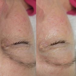 Victoria Beth Aesthetics - Before and after an eye treatment!