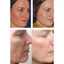Lashifeyed - Microneedling... forget the pain and plastic surgeon. Microneedling is what you need!