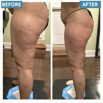 Alora Laser Spa - as she sent me the picture I want to share my results. - Skin Care Near Me - Warwick, New York Alora Laser Spa - as she sent me the picture I want to share my results. - Skin Care Near Me - Warwick, New York