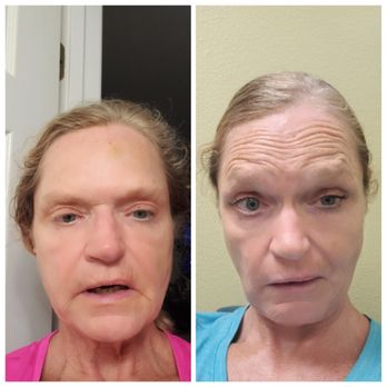 Arviv Medical Aesthetics - left is 2 days later and right is day of botox - Skin Care Near Me - Ocala, Florida