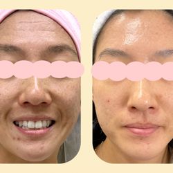 Laser acne scar treatment (8+ sessions) by Marie Jin, AG ACNP-BC