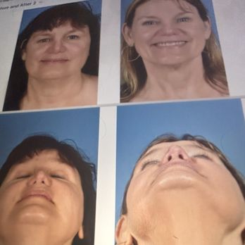 Jason Roostaeian, MD - Before and after - Cosmetic Surgeons Near Me - Los Angeles, California Jason Roostaeian, MD - Before and after - Cosmetic Surgeons Near Me - Los Angeles, California