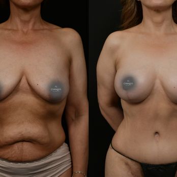 Changes Plastic Surgery & Spa - Autogolous Implant. Breast Lift. Lipo-360. Thigh Lift. Tummy Tuck. - Cosmetic Surgeons Near Me - San Diego, California
