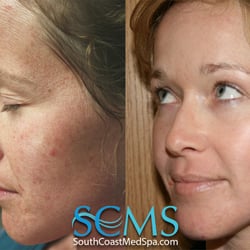 South Coast MedSpa - Skin resurfacing treatments at south coast medspa can help with pigments, sun damage, wrinkle removal and skin tightening. See website video