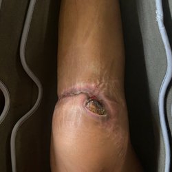UC Davis Sports Medicine - The exposed bone they left me with that died while I was very I'll.