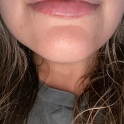 California Cosmetics - The day after my appointment. Swollen but very little bruising.