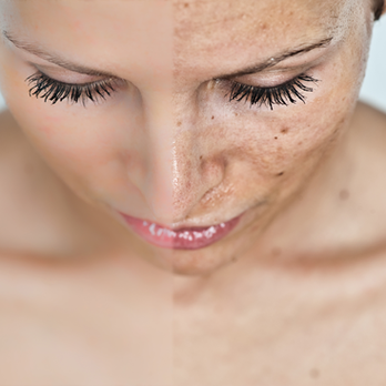 NouveauDerm Medspa - Say Bye Bye to Brown Spots with IPL Photorejuvenation! - Medical Spas Near Me - North Hampton, New Hampshire NouveauDerm Medspa - Say Bye Bye to Brown Spots with IPL Photorejuvenation! - Medical Spas Near Me - North Hampton, New Hampshire