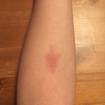 Bartell Drugs - The TB shot that Bartell's clinician injected which the UW nurses assessed as blood vessel damage bruise - Drugstores Near Me - Bellevue, Washington