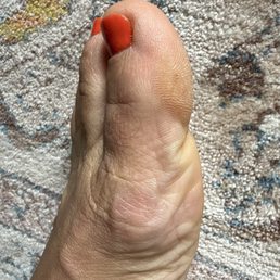 Calluses still remain on the sides of my toes. Calluses still remain on the sides of my toes.