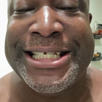 William J Cho, DDS, MS - Upper teeth before surgery. Surgery performed by Dr. William Cho. - Periodontists Near Me - Carlsbad, California