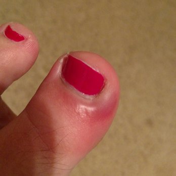 Lamorinda Nails - My lovely infected toe pre having to be sliced open by a doctor to drain. :( - Nail Salons Near Me - Lafayette, California Lamorinda Nails - My lovely infected toe pre having to be sliced open by a doctor to drain. :( - Nail Salons Near Me - Lafayette, California
