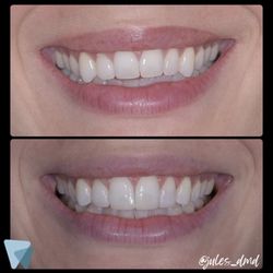 Huntington Bay Dental - Before & After by Dr. DeSimone!
