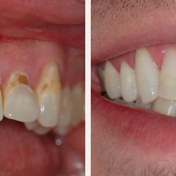 A Plus Dentistry - Before & After natural tooth colored fillings