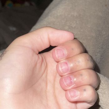EV Nail Studio - You can see where they were overfiled. - Nail Salons Near Me - Kent, Washington