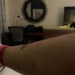 bug bites bug bites