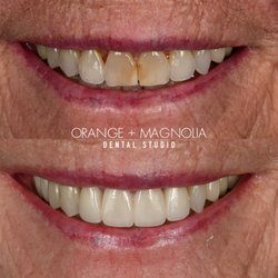 Orange and Magnolia Dental Studio - 4 porcelain veneers to turn back the clock