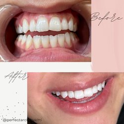 The Perfect Arch - Teeth Whitening  Immediate results !