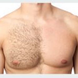 Skinsense - Laser hair removal is for men too!