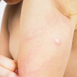 Watkins Allergy And Asthma Clinic - Jacksonville