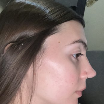 SKIN 101 - After aerolase. - Skin Care Near Me - Spring, Texas