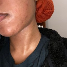 Before pic of skin