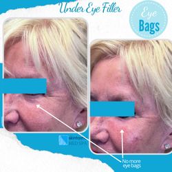 Skintastic Med Spa - Before & After of under eye/tear trough filler