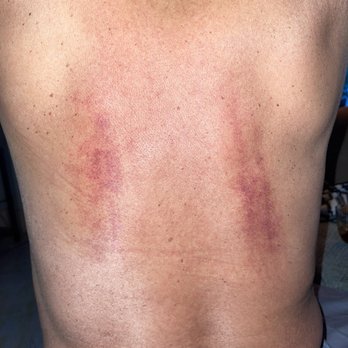 MaxRelax Spa - The day after the painful scrub - Massage Near Me - Lake Forest, California