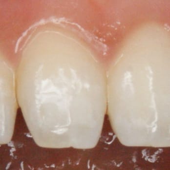 Anna K Choe, DDS - Before Bonding - General Dentistry Near Me - Pasadena, California