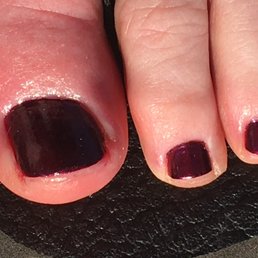 Toe is red and swollen. Toe is red and swollen.