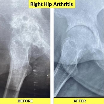 Glory Regenerative Center - Stage 4 (end stage) osteoarthritis of Right hip joint treated by our CEO - Dr. David Ikudayisi and he reversed the damage WITHOUT SURGERY. - Medical Spas Near Me - Tampa, Florida Glory Regenerative Center - Stage 4 (end stage) osteoarthritis of Right hip joint treated by our CEO - Dr. David Ikudayisi and he reversed the damage WITHOUT SURGERY. - Medical Spas Near Me - Tampa, Florida