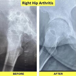 Glory Regenerative Center - Stage 4 (end stage) osteoarthritis of Right hip joint treated by our CEO - Dr. David Ikudayisi and he reversed the damage WITHOUT SURGERY.