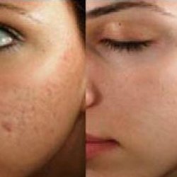 BestBodyRX - Microneedling