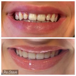 Carmel Family Dental - Bonding of laterals only