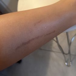 Northern Virginia Wellness Center - Large burn line on back of leg. This was the last part to be treated, she was talking while done and felt like she was going very slow