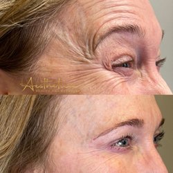 Aesthetica - Botox to crows feet