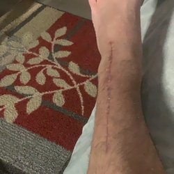 South Shore Hospital - Broken ankle