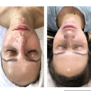 Rachael Ostrea, LE - 1 week after chemical peel - Permanent Makeup Near Me - Marina del Rey, California Rachael Ostrea, LE - 1 week after chemical peel - Permanent Makeup Near Me - Marina del Rey, California