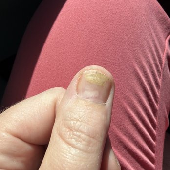 Bliss Nail Spa - This is a photo of what they did to my nail with acrylics... this is about a month grown out. - Nail Salons Near Me - Everett, Washington Bliss Nail Spa - This is a photo of what they did to my nail with acrylics... this is about a month grown out. - Nail Salons Near Me - Everett, Washington