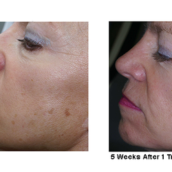Laser Aesthetic Center - Laser for Sun or Dark Spots