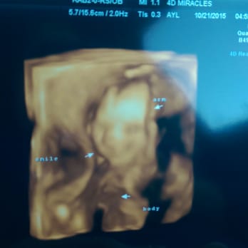4D Miracles - My little girl smiling. First time seeing her in 4D ultrasound 21weeks - Ultrasound Imaging Centers Near Me - Fremont, California 4D Miracles - My little girl smiling. First time seeing her in 4D ultrasound 21weeks - Ultrasound Imaging Centers Near Me - Fremont, California